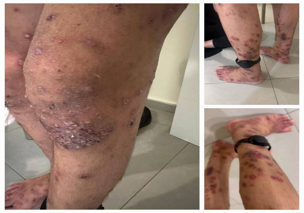 آثار مرض الجرب على جسد الطفل إياد ادعيس الذي أفرج الاحتلال عنه اليوم بشروط